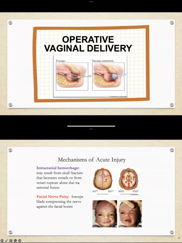 Operative Vaginal Delivery | PDF