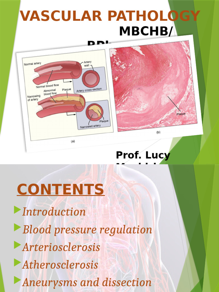 Understanding Vascular Pathology Essentials | PDF | Atheroma ...