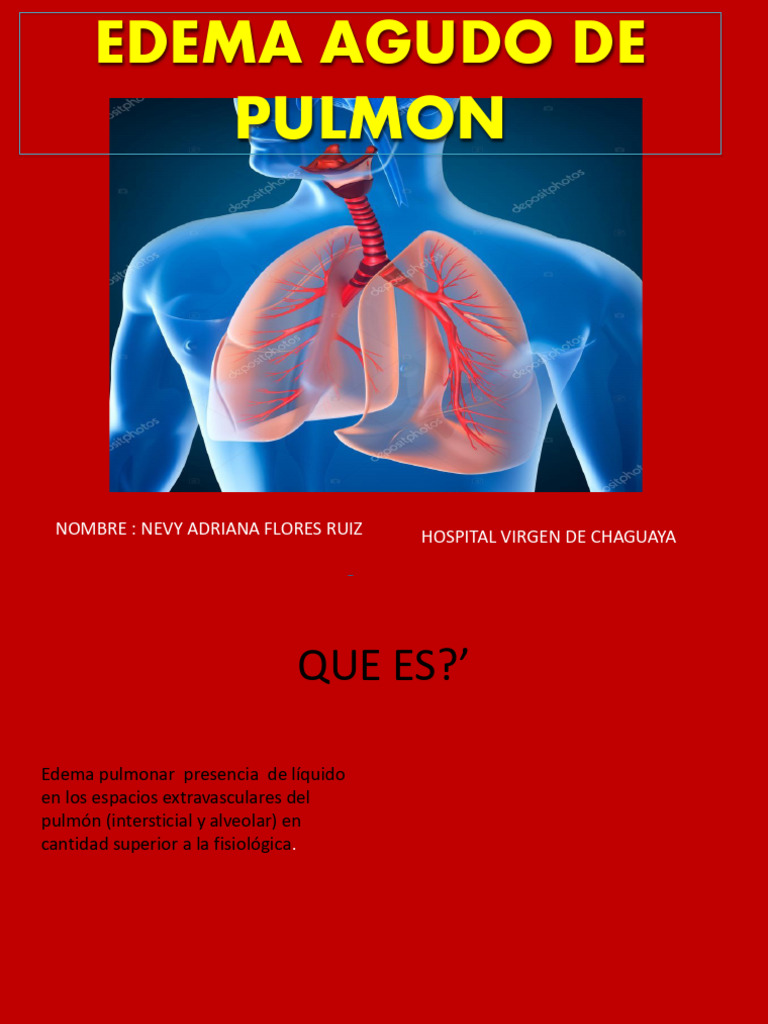 Edema Agudo de Plmon para Disertar | PDF | Edema | Capilar