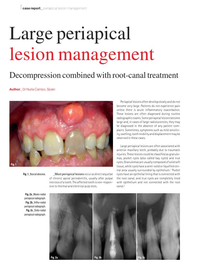 Large Lesion Management - Roots0112 | PDF | Dental Anatomy | Mouth