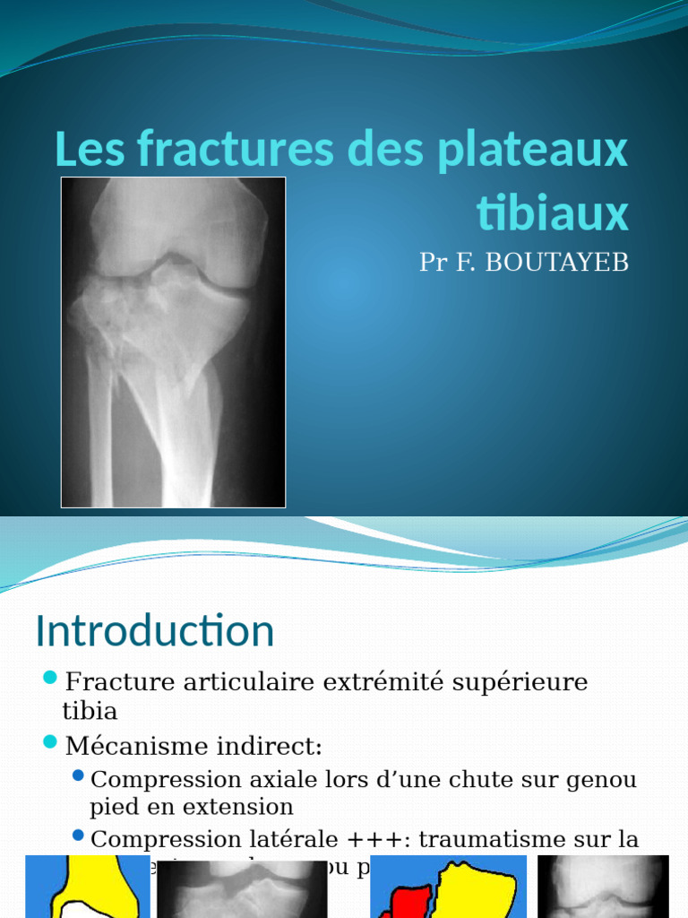 classification-et-traitement-des-fractures-tibiales-pdf