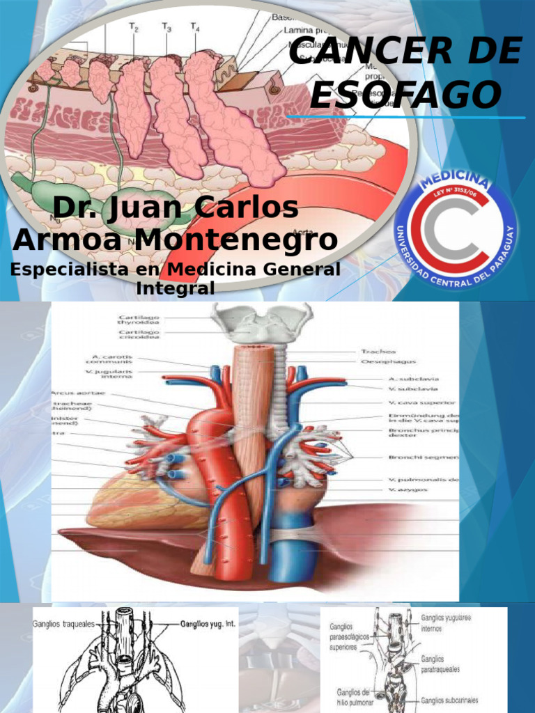 Tratamientos y Estrategias en Cáncer de Esófago | PDF | Cáncer | Cáncer ...