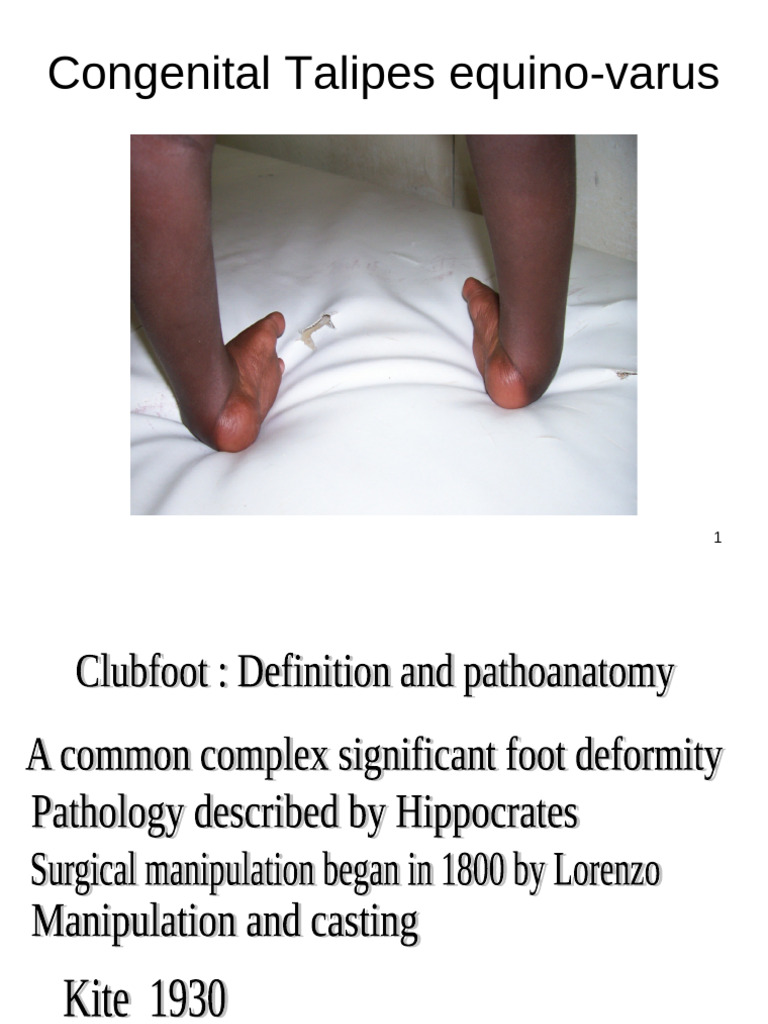 Clubfoot: Anatomy, Diagnosis, Treatment | PDF | Foot | Anatomical Terms ...