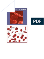 SICKLEMIA-PENYAKIT