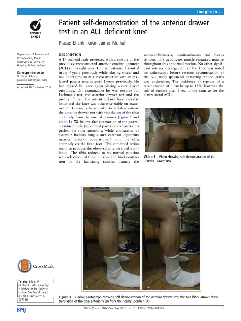 Patient Self-Demonstration of The Anterior Drawer | PDF | Knee | Soft ...