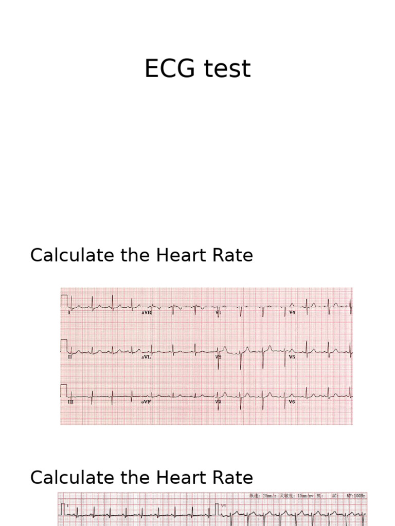 ECG Test | PDF