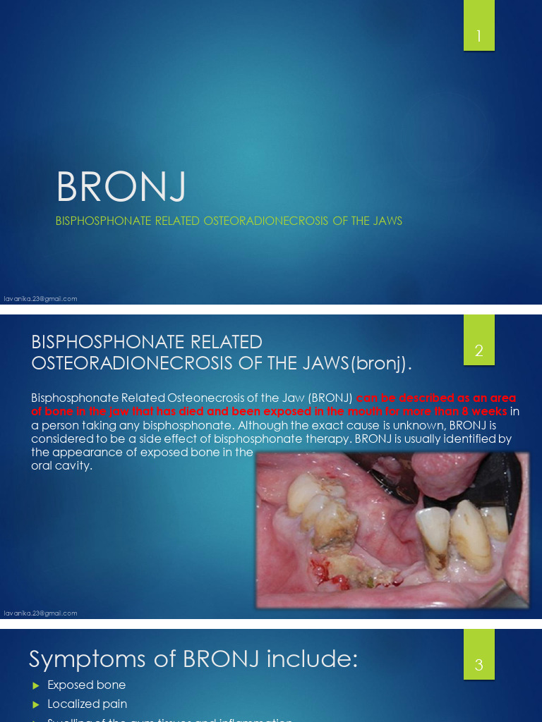 Understanding BRONJ in Bisphosphonate Therapy | PDF | Diseases And ...