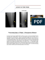 Penetrating Femoral Wound