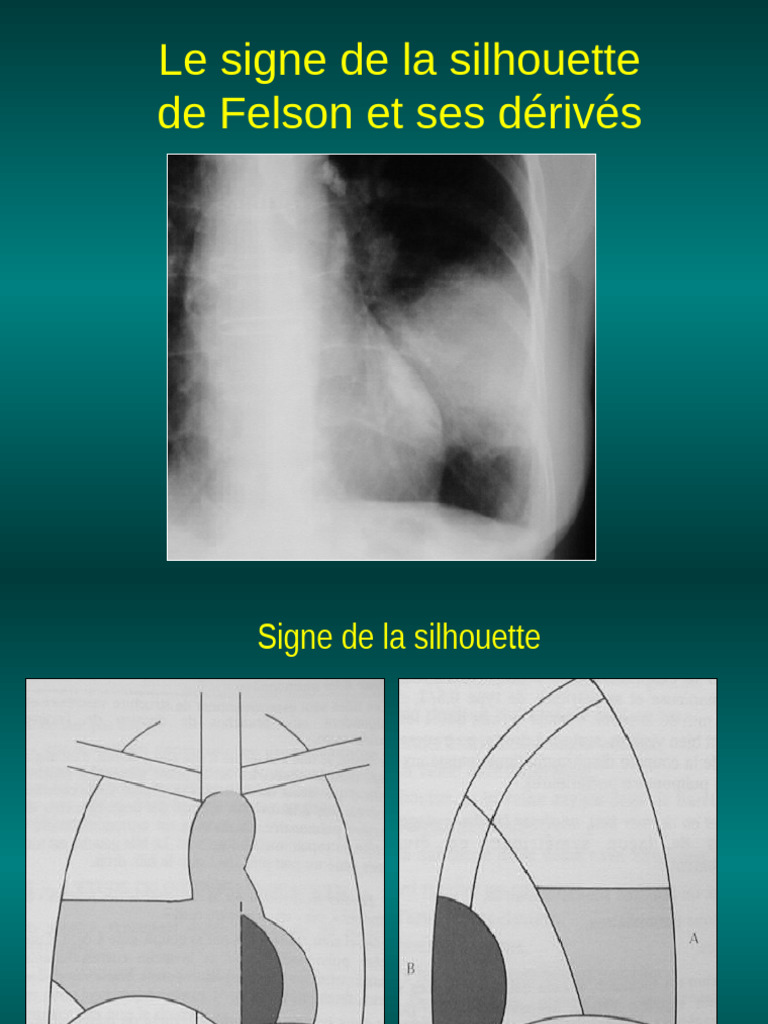 Signe de la silhouette en radiologie | PDF | Aorte | Thorax