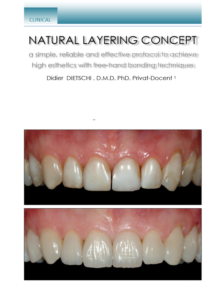 Natural Layering Concept in Dentistry | PDF | Tooth Enamel | Orthodontics