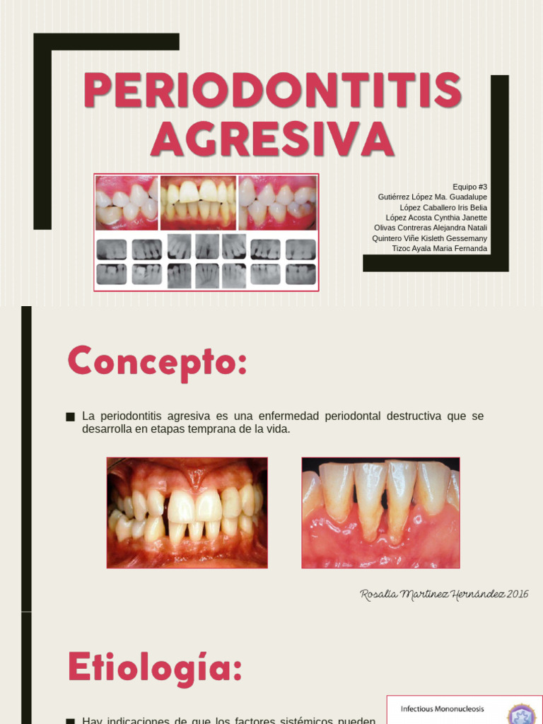 Periodontitis Agresiva | PDF | Inmunología | Especialidades Medicas