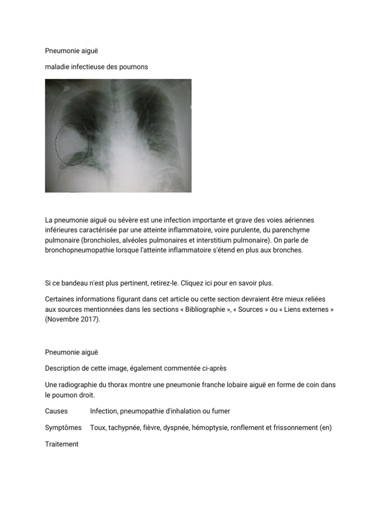 Pneumonie aiguë : causes et traitements | PDF | Pneumonie | Maladie ...