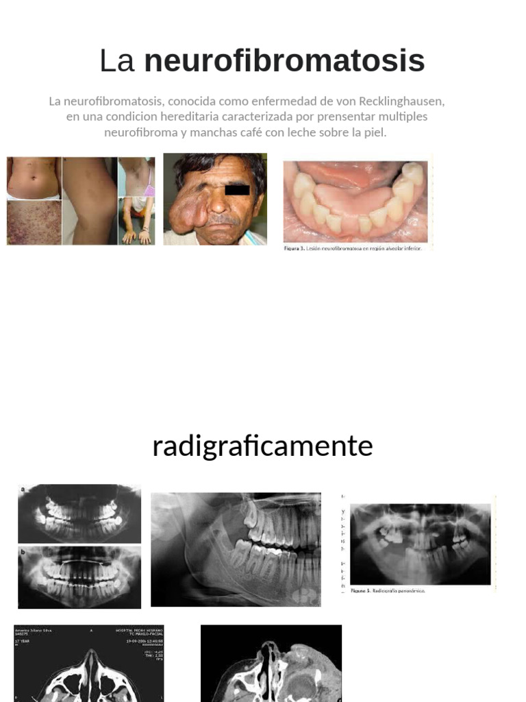 Torus Mandibular | PDF
