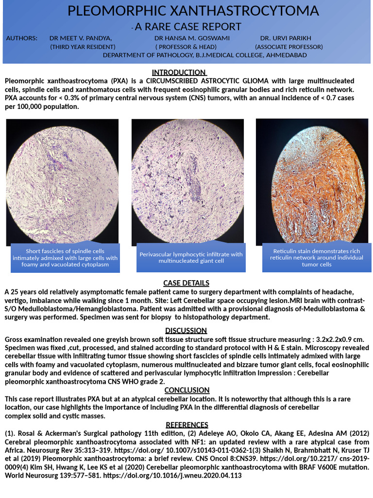 Rare Cerebellar Pleomorphic Xanthoastrocytoma Case | PDF