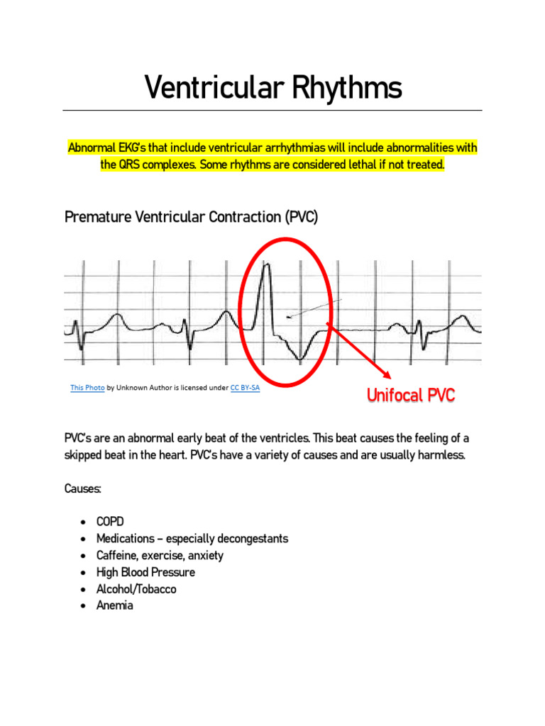 Trigeminal PVCs Explained | PDF
