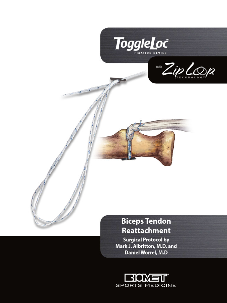 BSM0191.1 Toggleloc Biceps Dista Percutaneo | PDF | Implant (Medicine ...