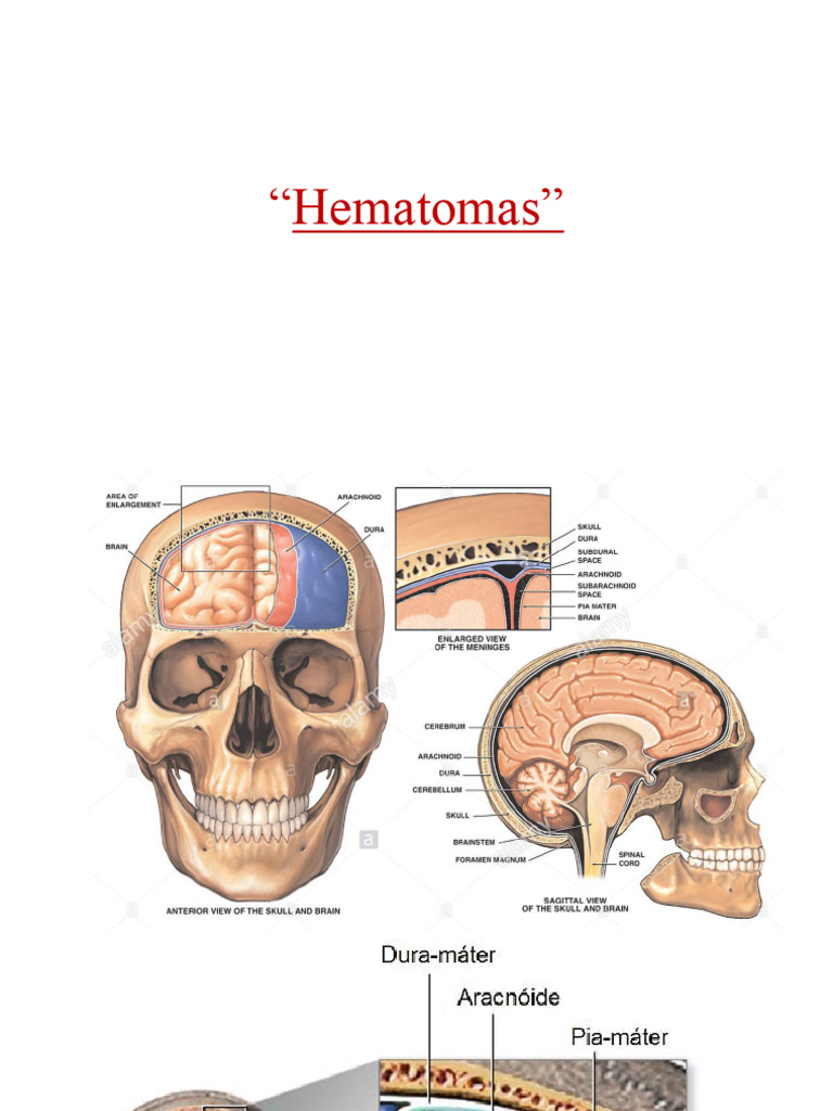 Hematomas e Hemorragias Cerebrais | PDF