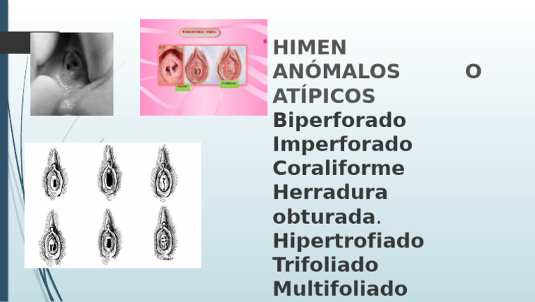 Tipos de Himen Anómalos y Atípicos | PDF