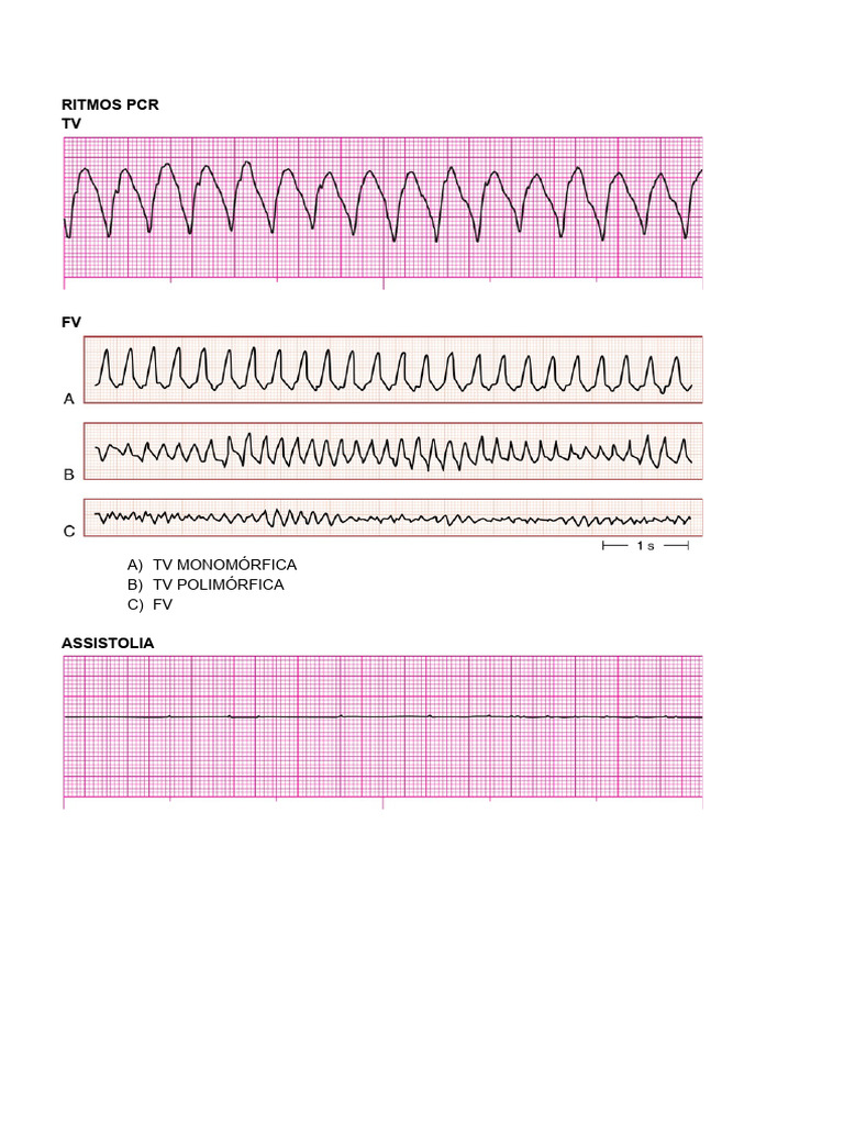 Algoritmos de Arritmias em ACLS | PDF
