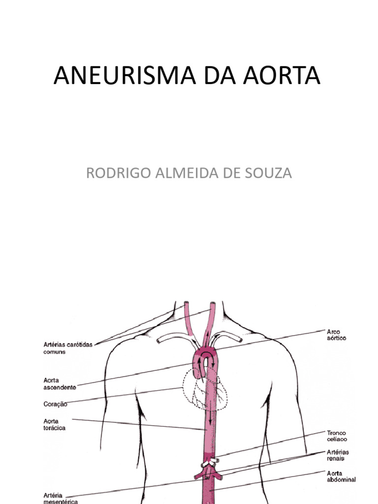 Aneurisma da Aorta: Sintomas e Tratamentos | PDF | Angiologia ...