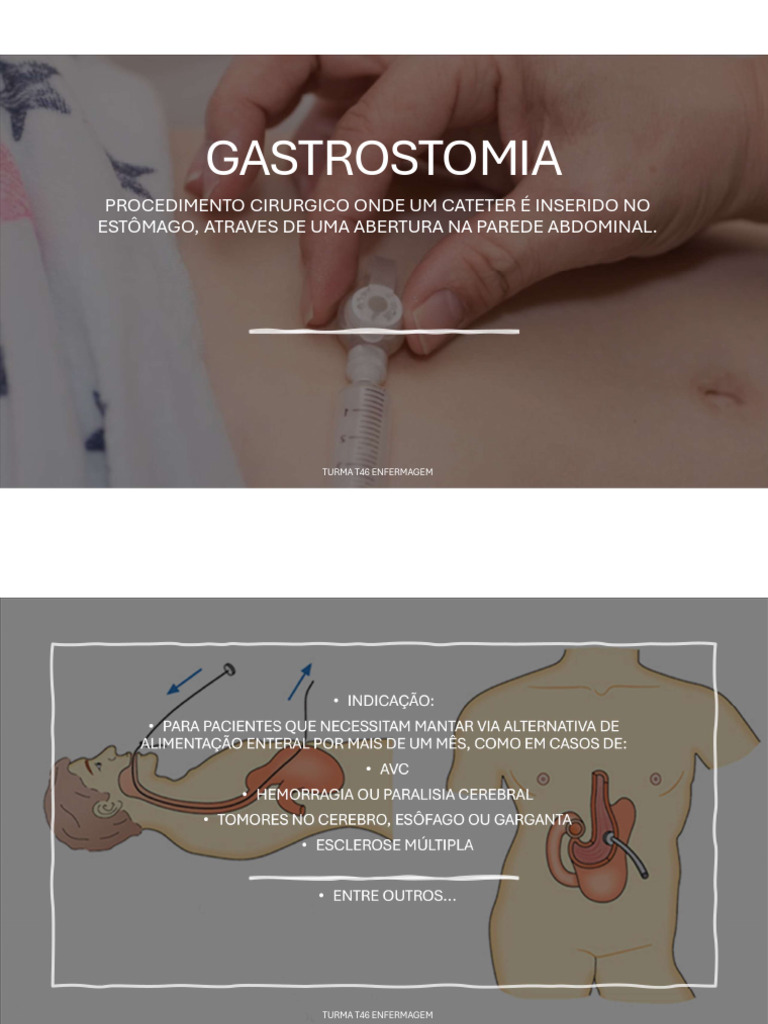 Indicações para Gastrostomia | PDF