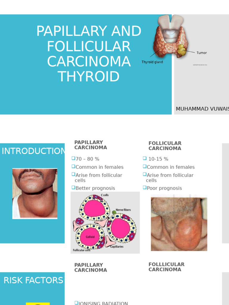 Papillary and Follicular Carcinoma Thyroid | PDF | Thyroid | Medical ...