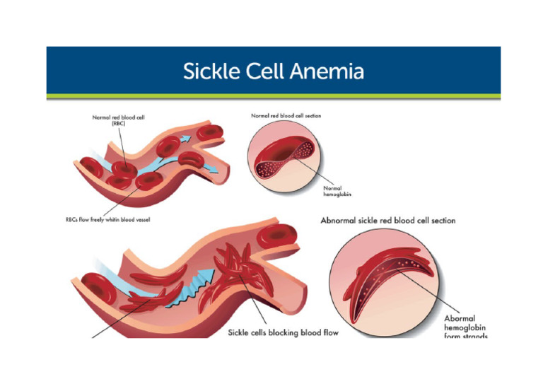 Sickle Cell Image | PDF