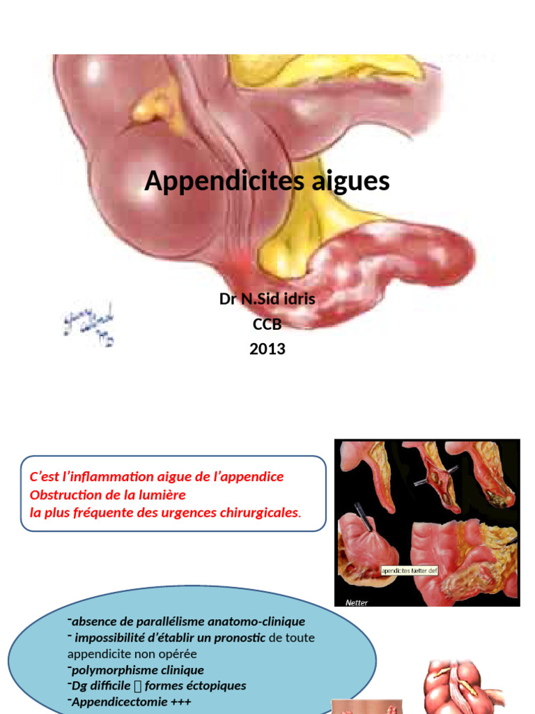 comprendre-l-appendicite-aigu-causes-et-diagnostics-pdf