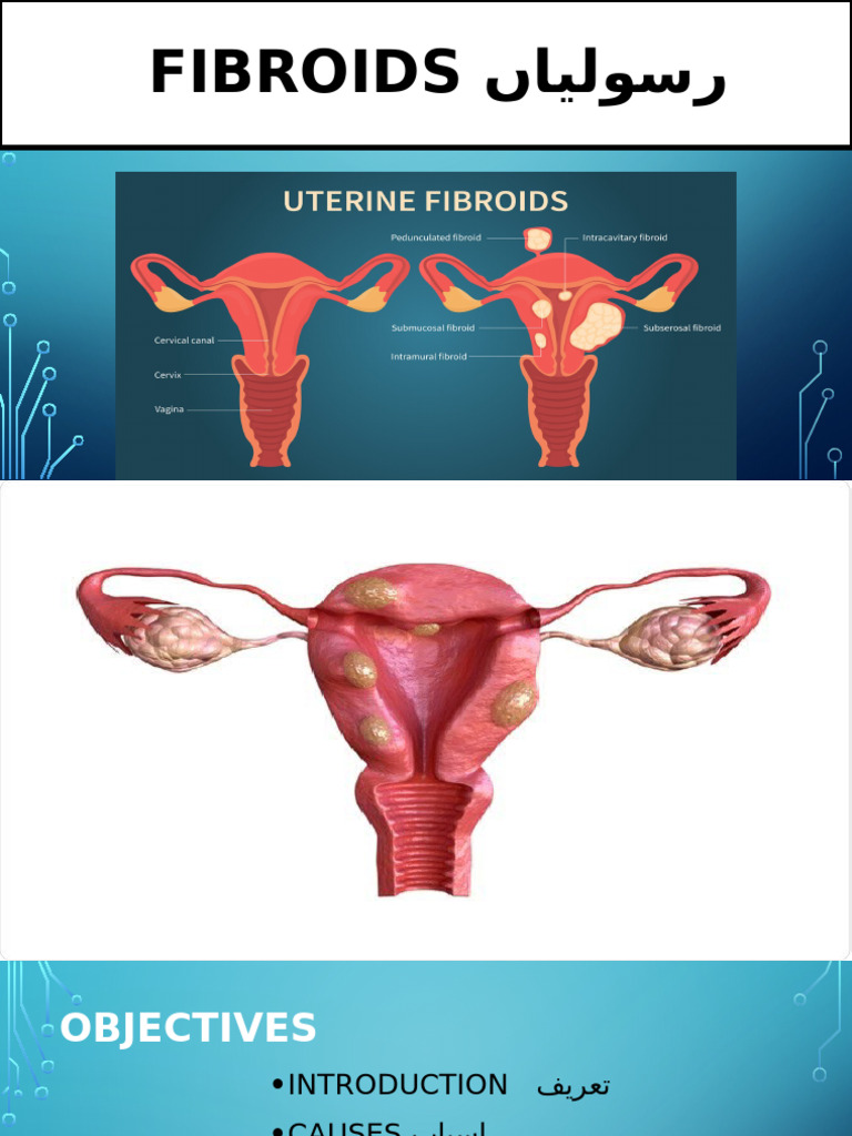 FIBROIDS ںایلوسر | PDF