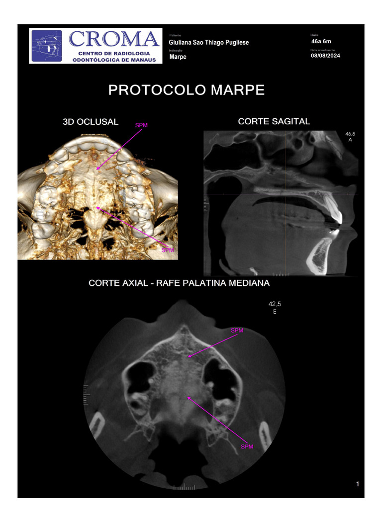 Laudo de Tomografia MARPE Detalhado | PDF