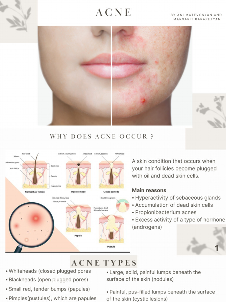 Acne PDF | PDF