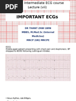 Right Ventricular Infarction Litfl Ecg Library Diagnosis Pdf