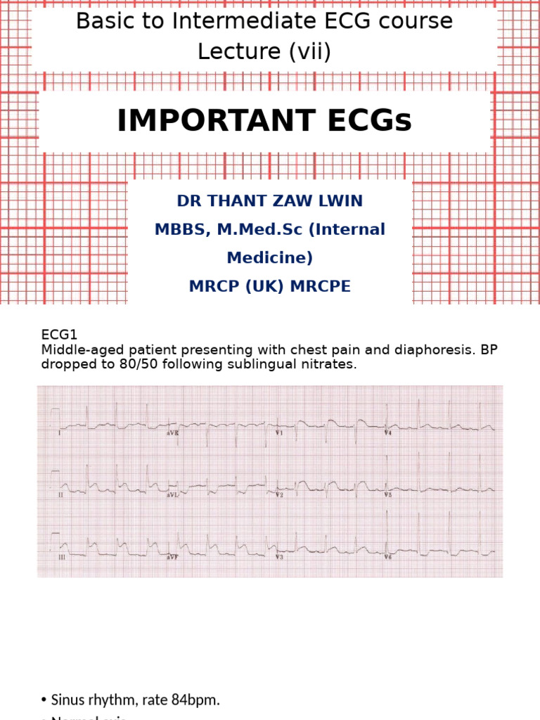ECG Lect 7 | PDF | Electrocardiography | Cardiac Arrhythmia