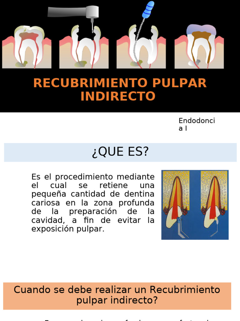 Recubrimiento Pulpar Indirecto: Guía Clínica | PDF | Especialidades ...