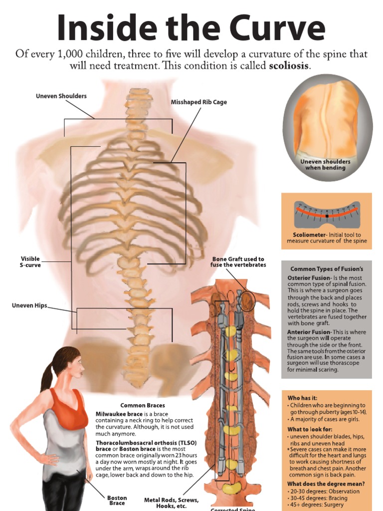 Misshaped Rib Cage Uneven Shoulders PDF Musculoskeletal System