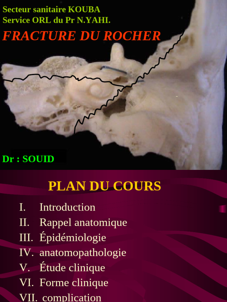 fracture-du-rocher-2017-pdf-traumatisme-cr-nien-vertige