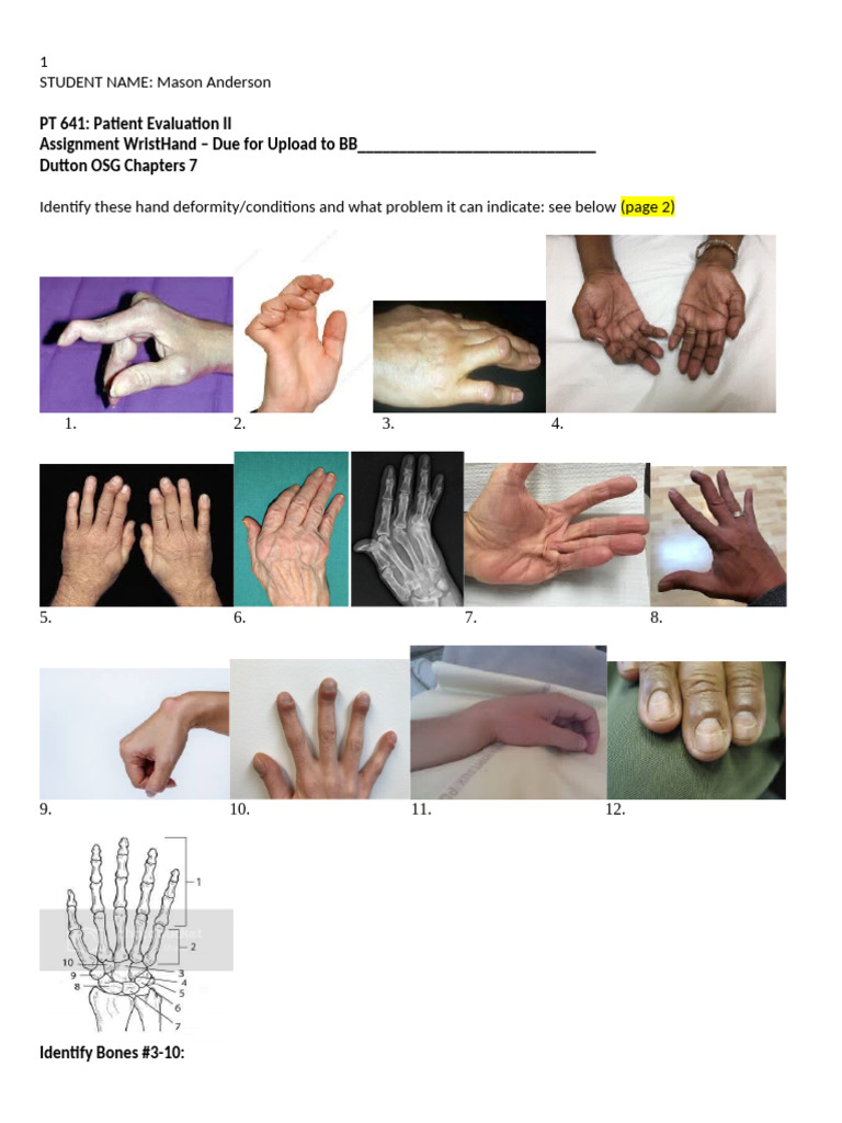Hand Deformities and Conditions Analysis | PDF
