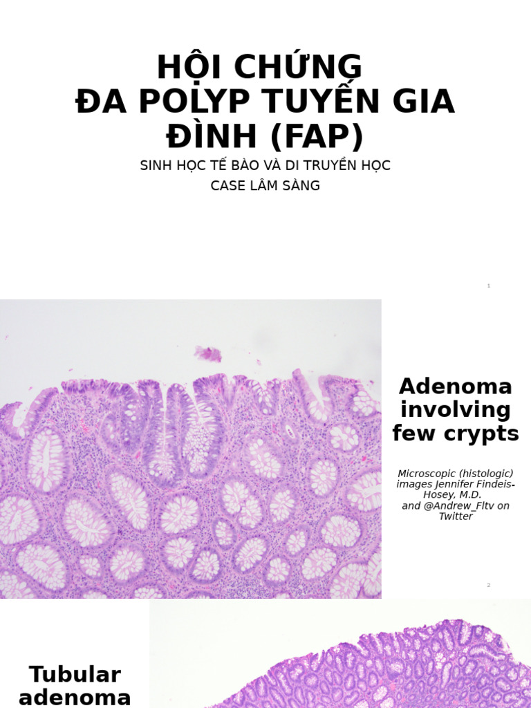 CASE Hội Chứng Đa Polyp Tuyến Gia Đình | PDF