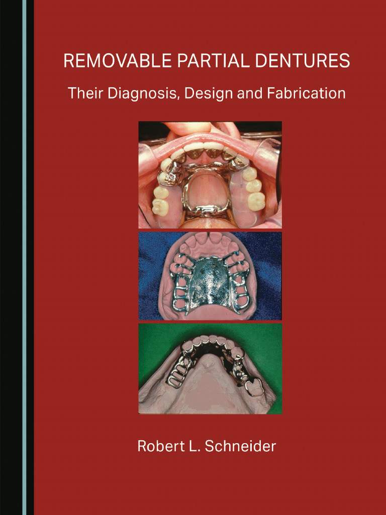 Removable Partial Dentures - Their Diagnosis, Design and Fabrication ...