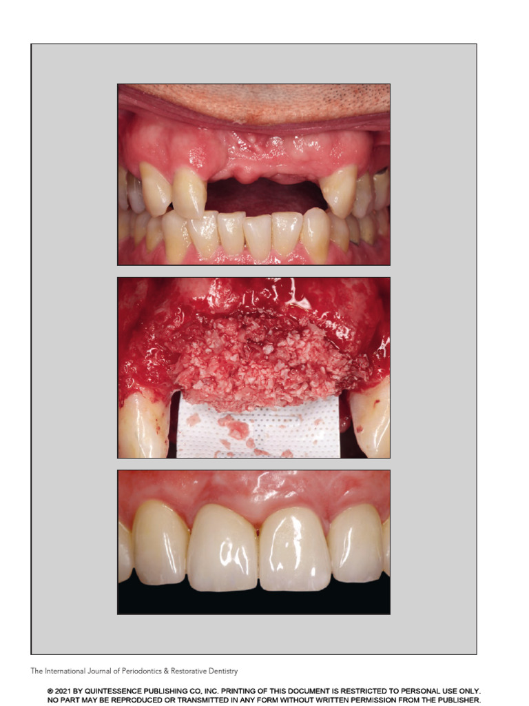 Ijprd 2021 Vol.41 p.169 175 | PDF | Dental Implant | Periodontology
