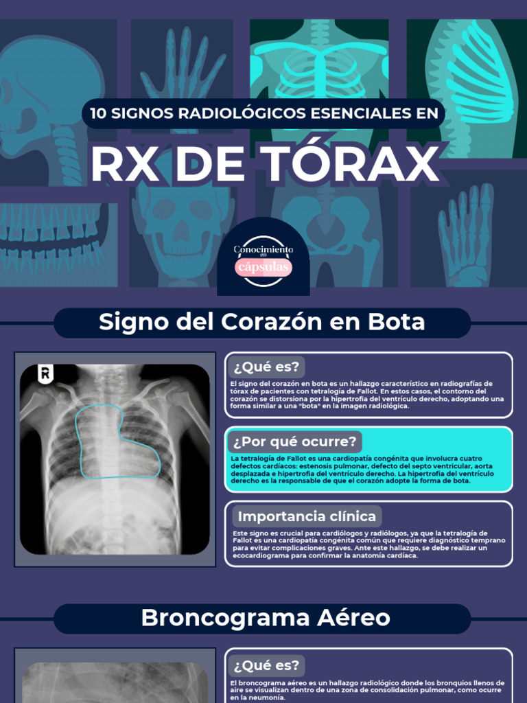 Signos Radiológicos de Embolia Pulmonar | PDF | Embolia | Pulmón
