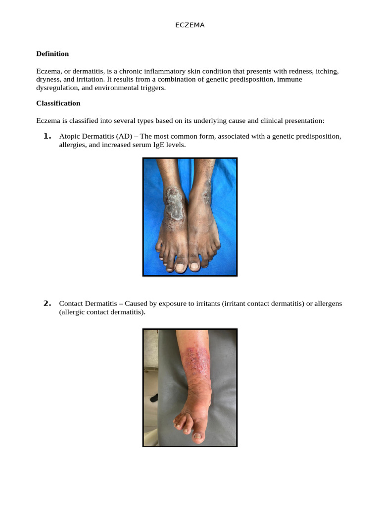 Understanding Eczema: Causes and Treatments | PDF | Dermatitis | Allergy