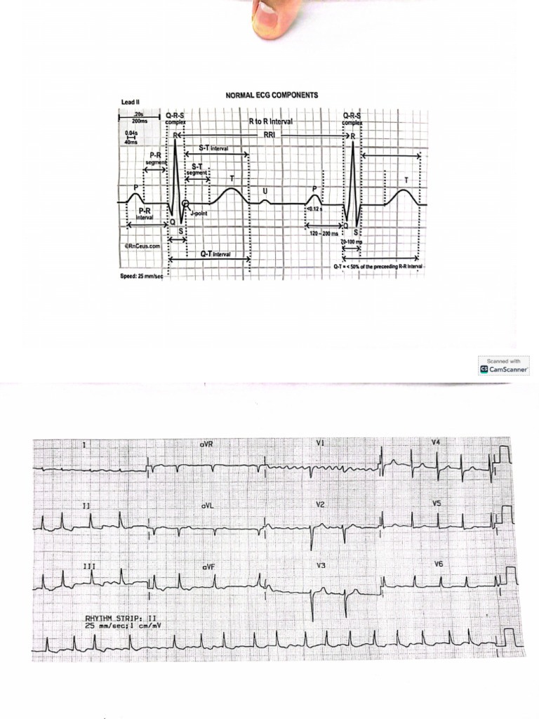 Ecg | PDF