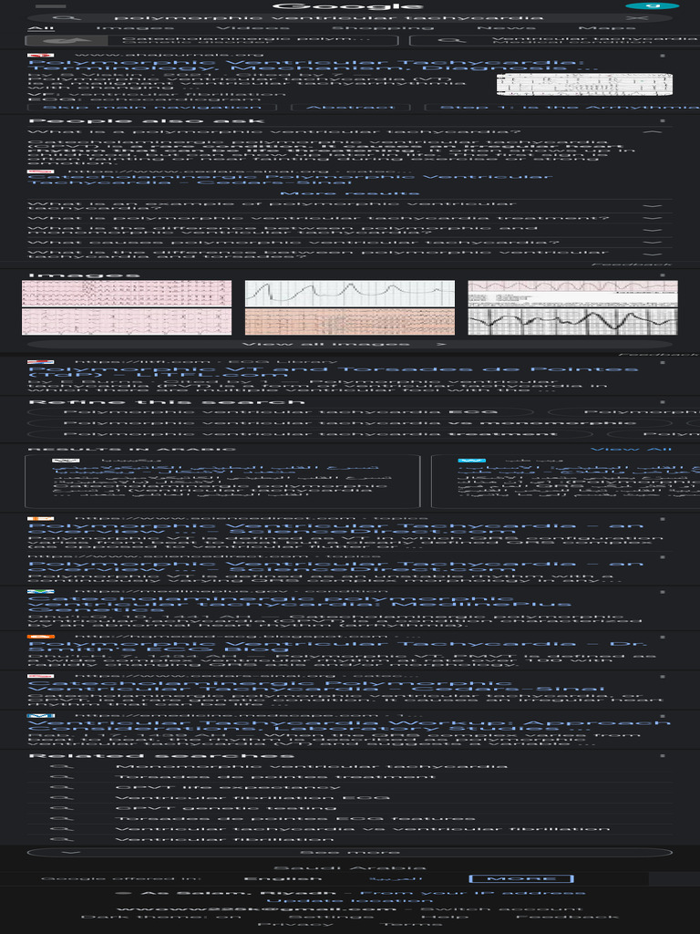 Polymorphic Ventricular Tachycardia - Google Search | PDF | Medical ...