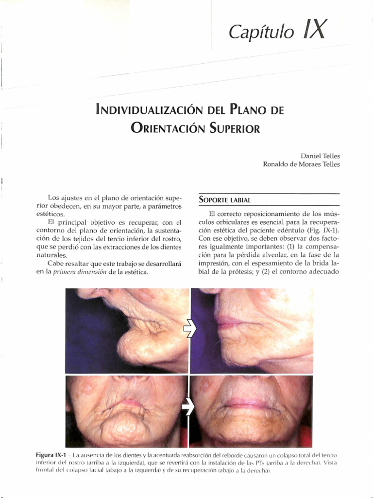 Soporte Labial en Prótesis Total | PDF