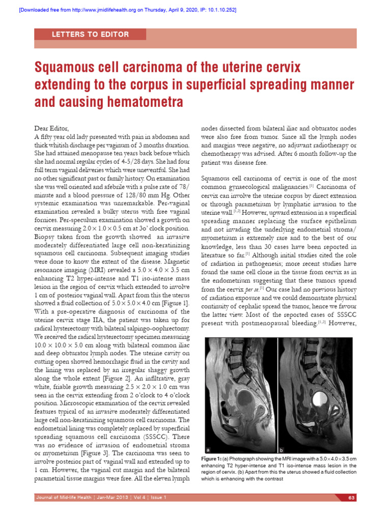 Squamous Cell Carcinoma of The Uterine Cervix | PDF | Uterus | Anatomy