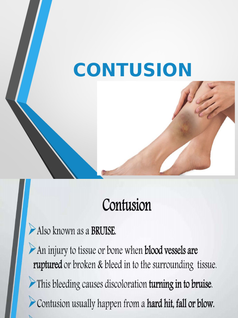 Contusionppt | PDF