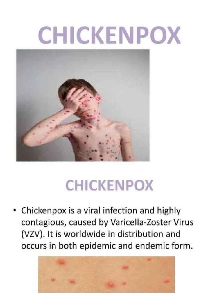 Commu Chickenpox | PDF
