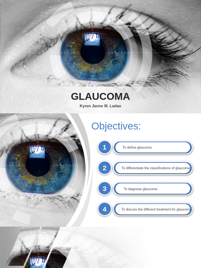 1be5 Glaucoma | PDF | Glaucoma | Ophthalmology