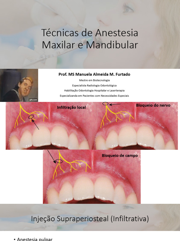 Técnicas de Anestesia Maxilar e Mandibular | PDF | Boca | Anatomia humana